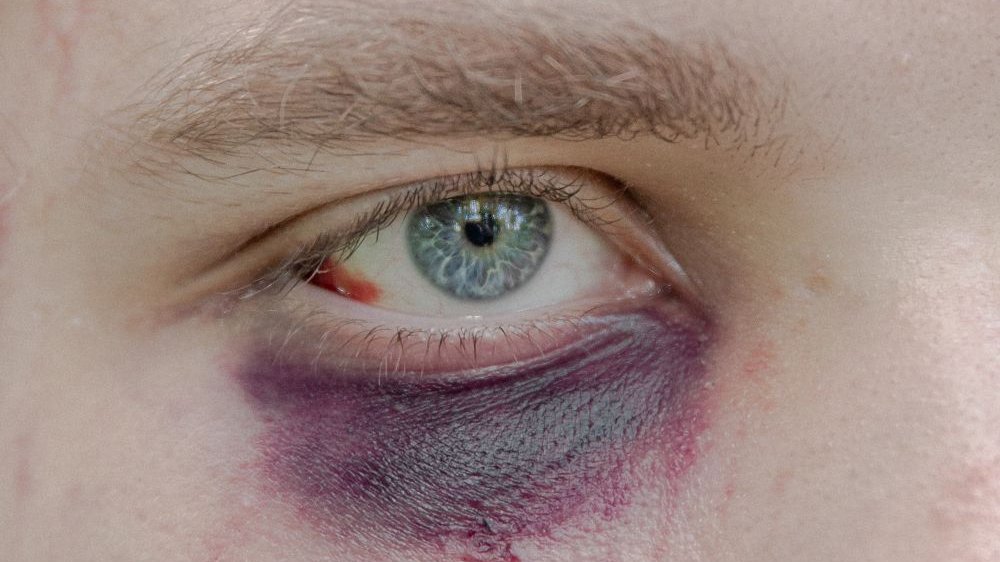 Photo of the light blue eye with a bruise under it. - grafika artykułu