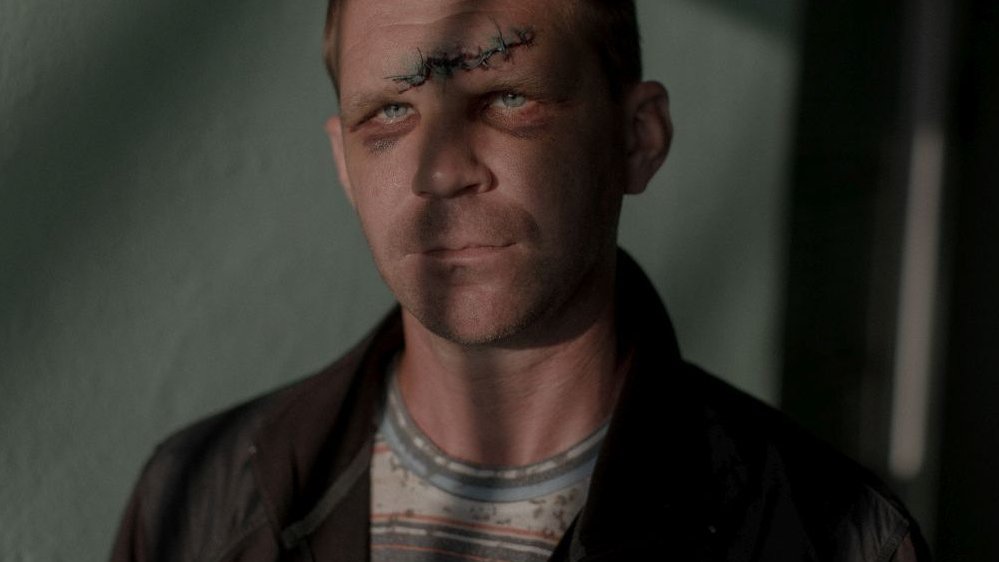 Photo of a man with seamed wound on the forehead.